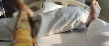 加油时一个举动，男子特重度烧伤，致终身伤残！加油站赔偿约24.5万元→